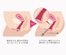 膣内ヒアルロン酸注入