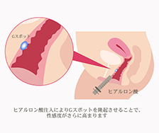 Gスポットヒアルロン酸注入