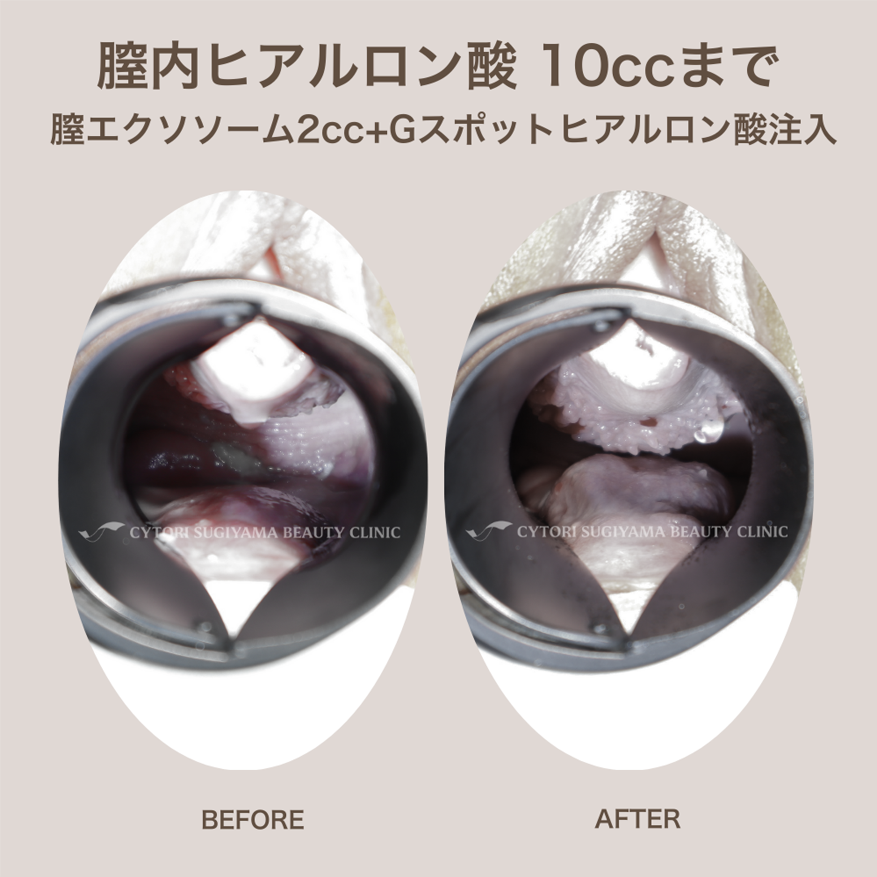 膣内ヒアルロン酸注入 10本まで+膣エクソソーム2cc+Gスポットヒアルロン酸注入