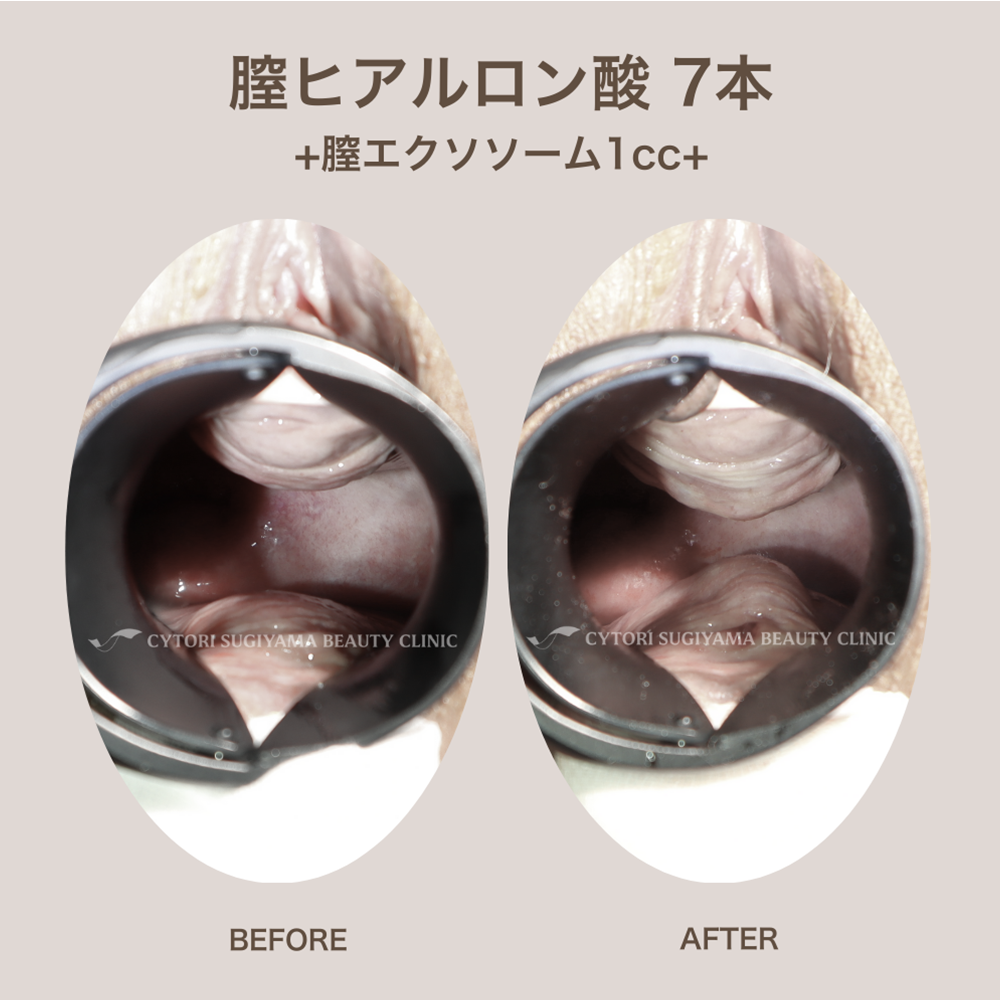 膣内ヒアルロン酸注入 7本＋膣エクソソーム1cc