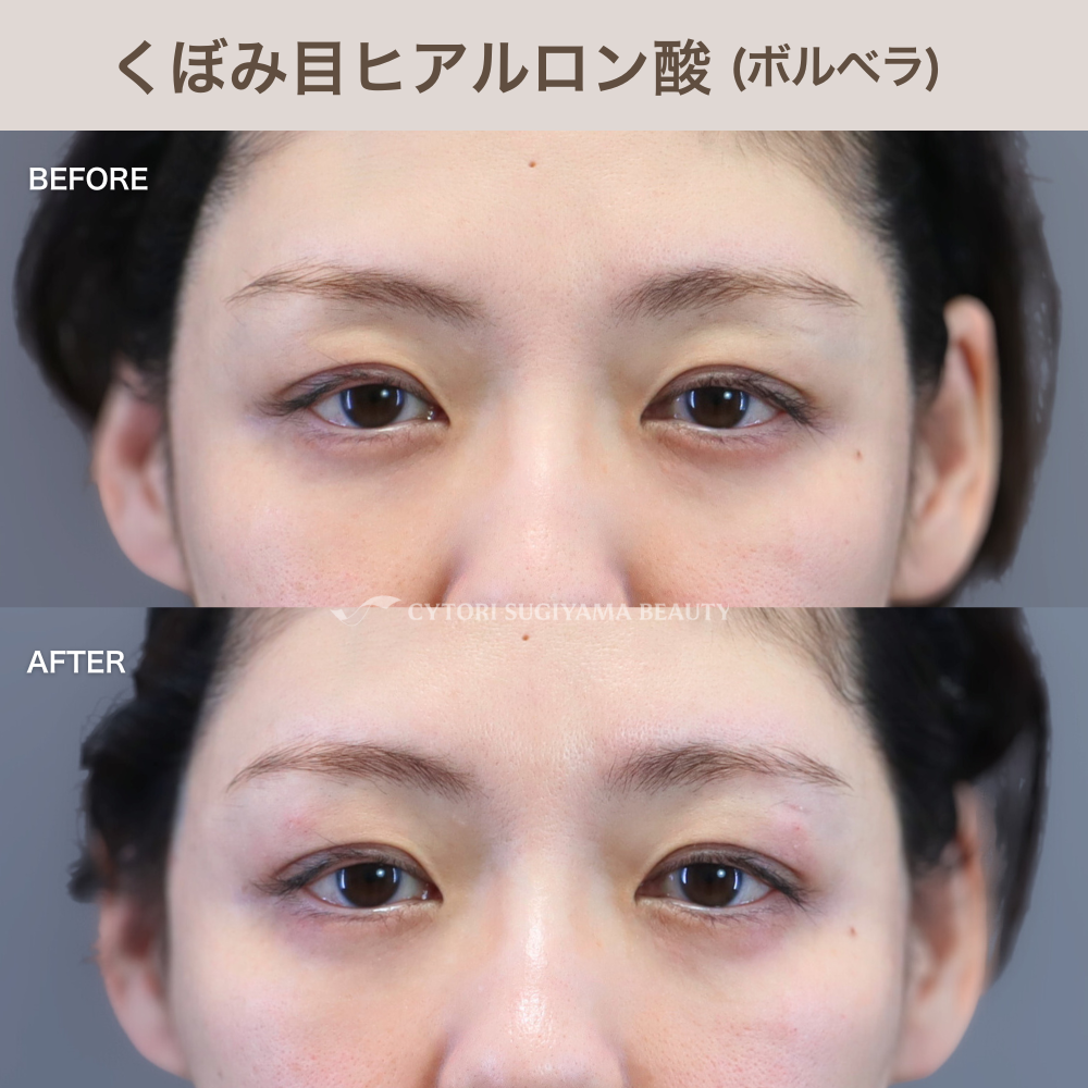 くぼみ目ヒアルロン酸