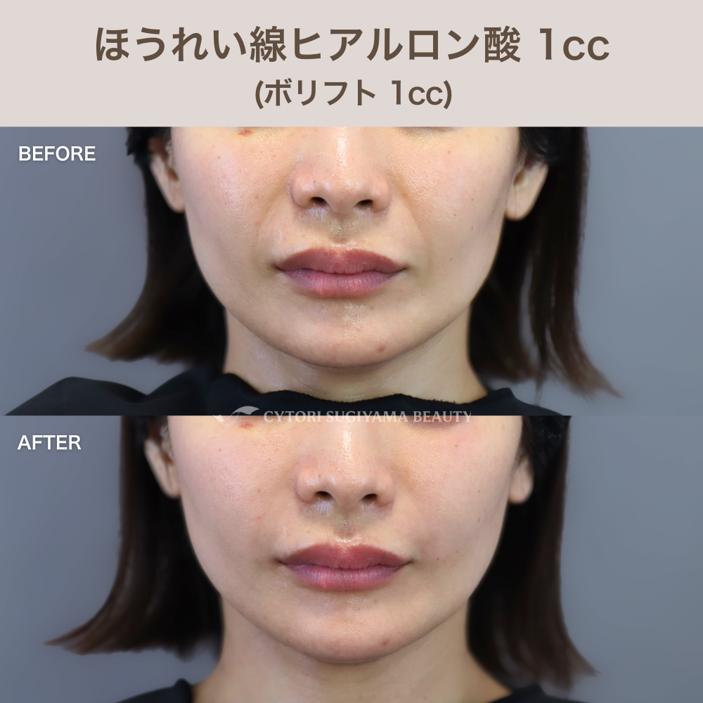 ほうれい線ヒアルロン酸 1cc