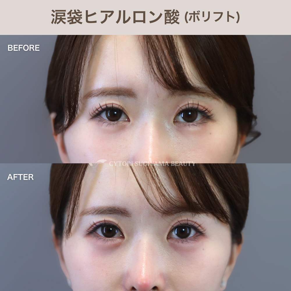 涙袋ヒアルロン酸 1cc