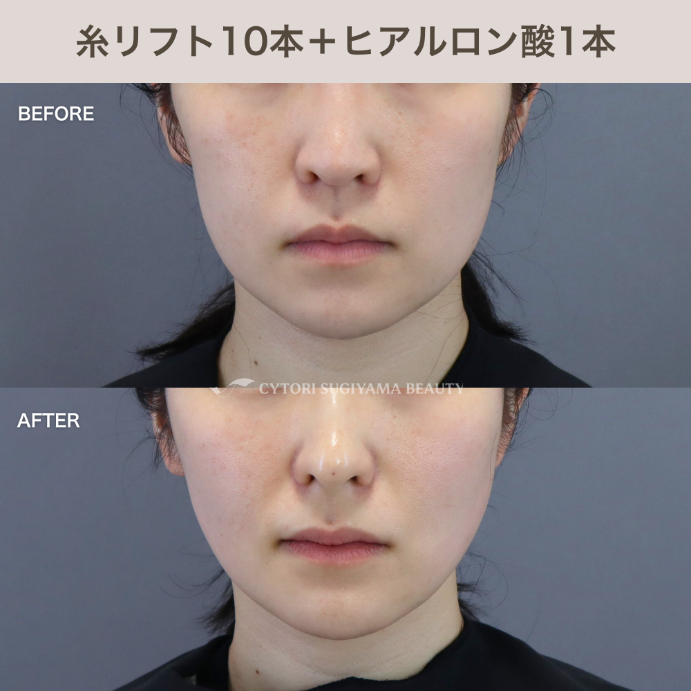 糸リフト10本＋ヒアルロン酸1本