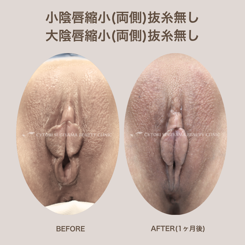 小陰唇縮小(両側) 抜糸無し＋大陰唇縮小(両側) 抜糸無し