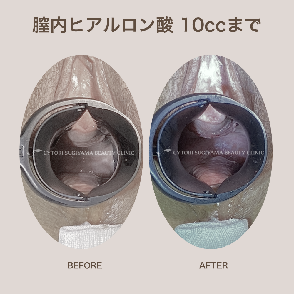 膣内ヒアルロン酸注入 10本まで