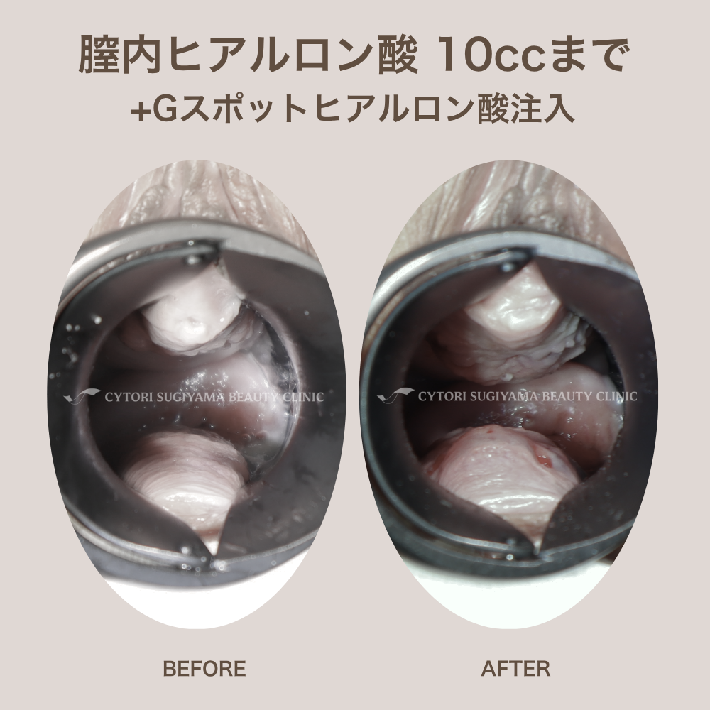 膣内ヒアルロン酸注入 10本まで+Gスポットヒアルロン酸注入