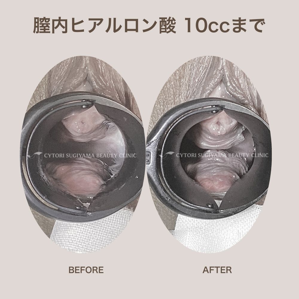 膣内ヒアルロン酸注入 10本まで