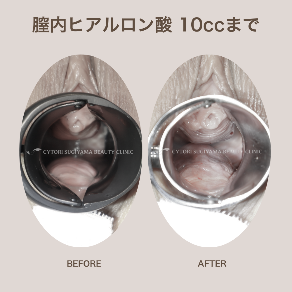 膣内ヒアルロン酸注入 10本まで