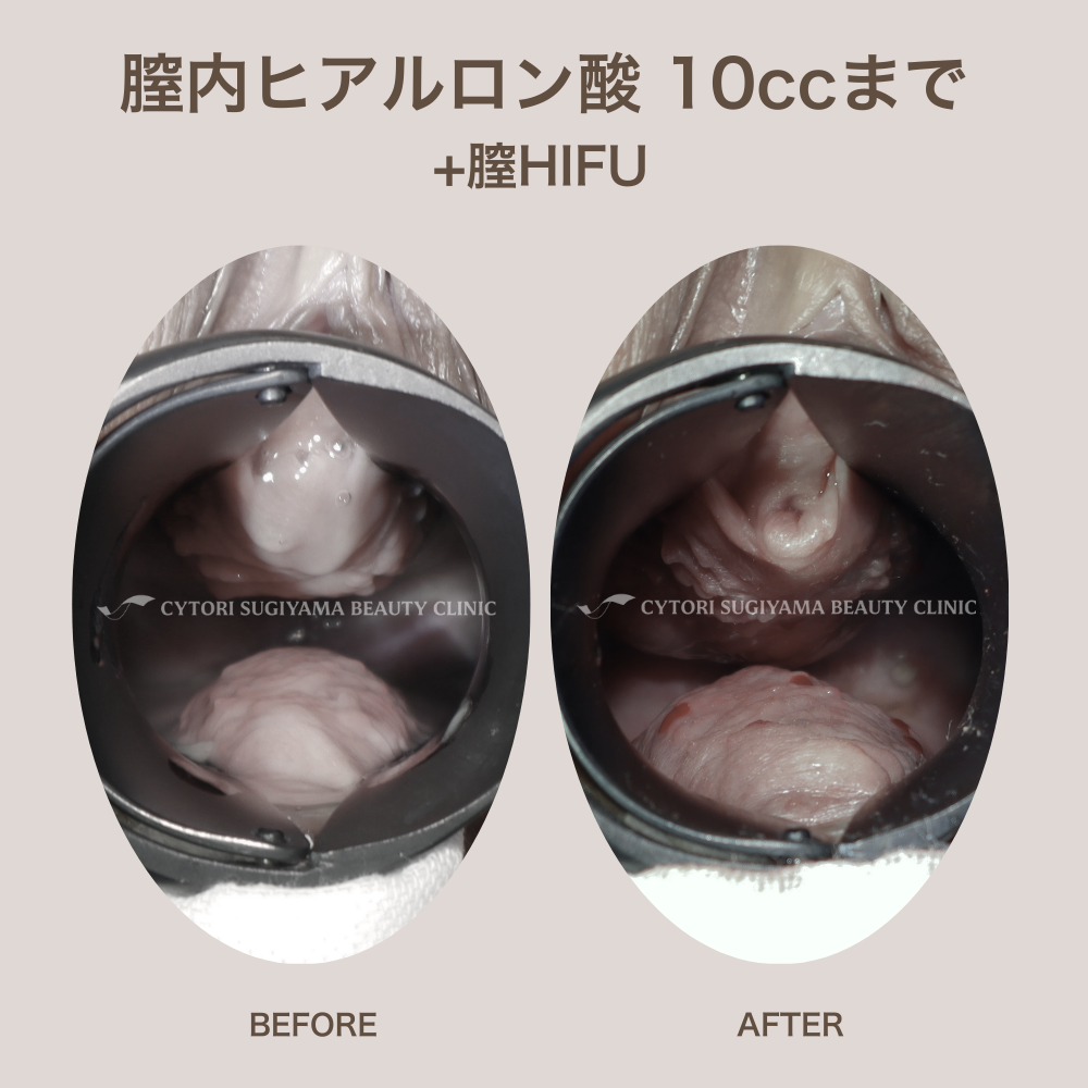 膣内ヒアルロン酸注入 10本まで+膣HIFU