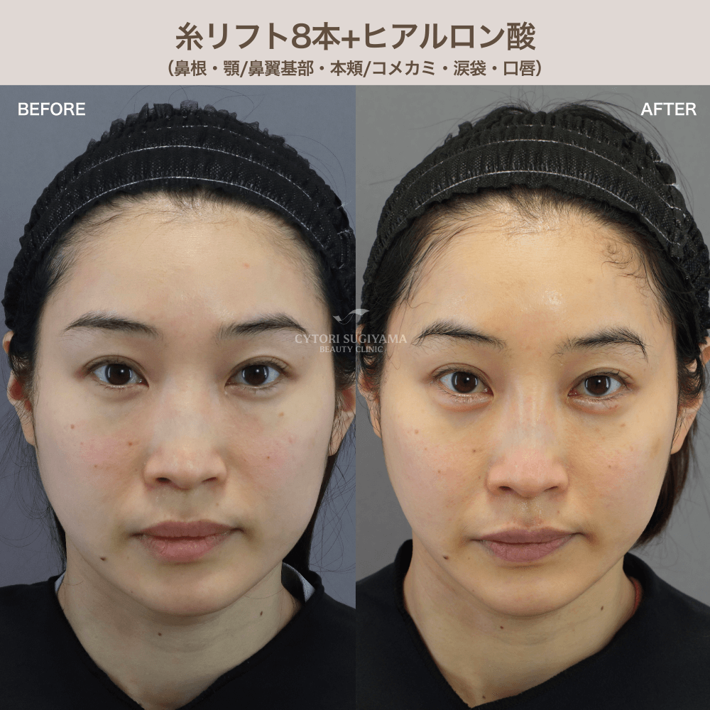 糸リフト8本＋ヒアルロン酸4本