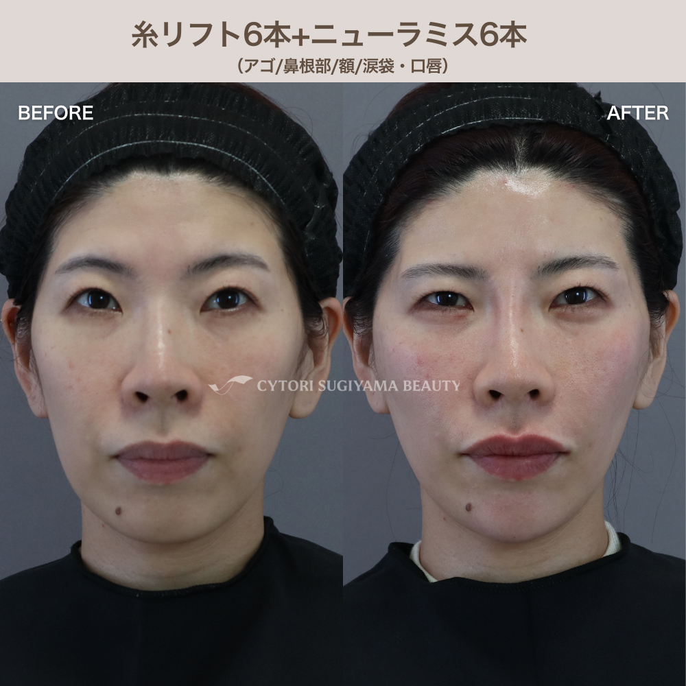 糸リフト6本＋ヒアルロン酸6本