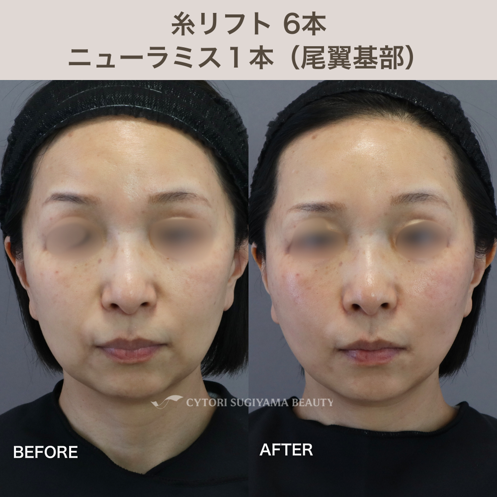 糸リフト6本＋ヒアルロン酸1本