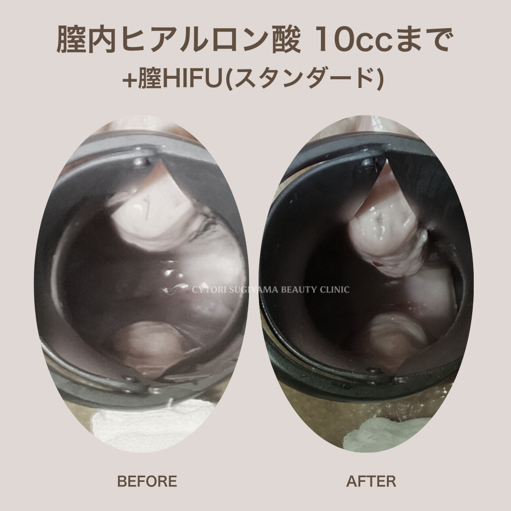 膣内ヒアルロン酸注入 10本まで+膣HIFU