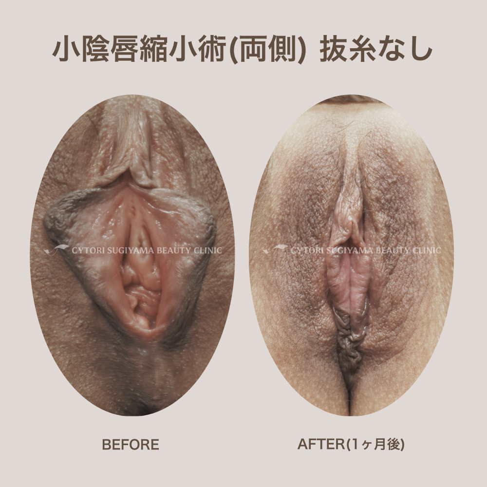 小陰唇縮小(両側) 抜糸無し