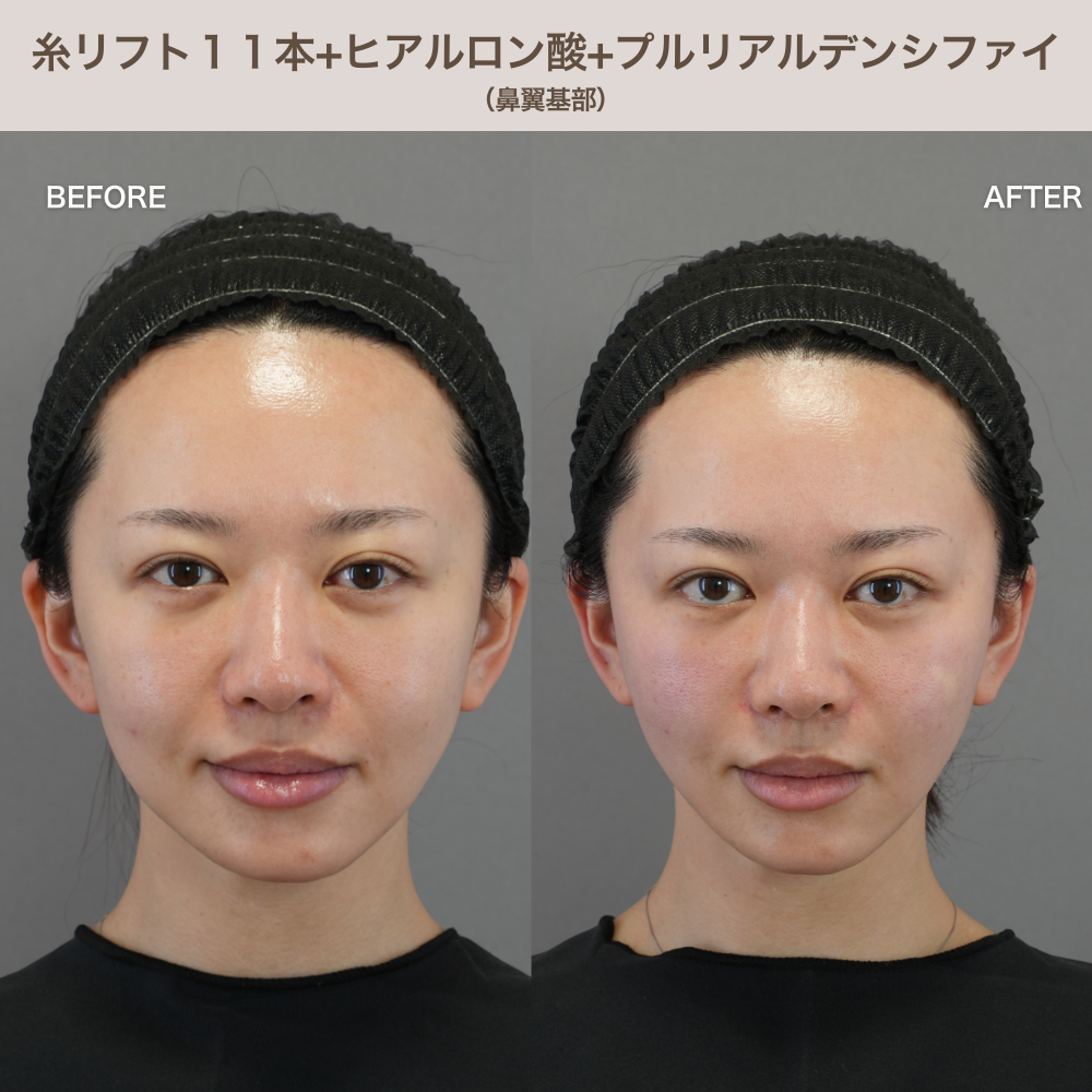 糸リフト11本＋ヒアルロン酸4本＋プルリアルデンシファイ