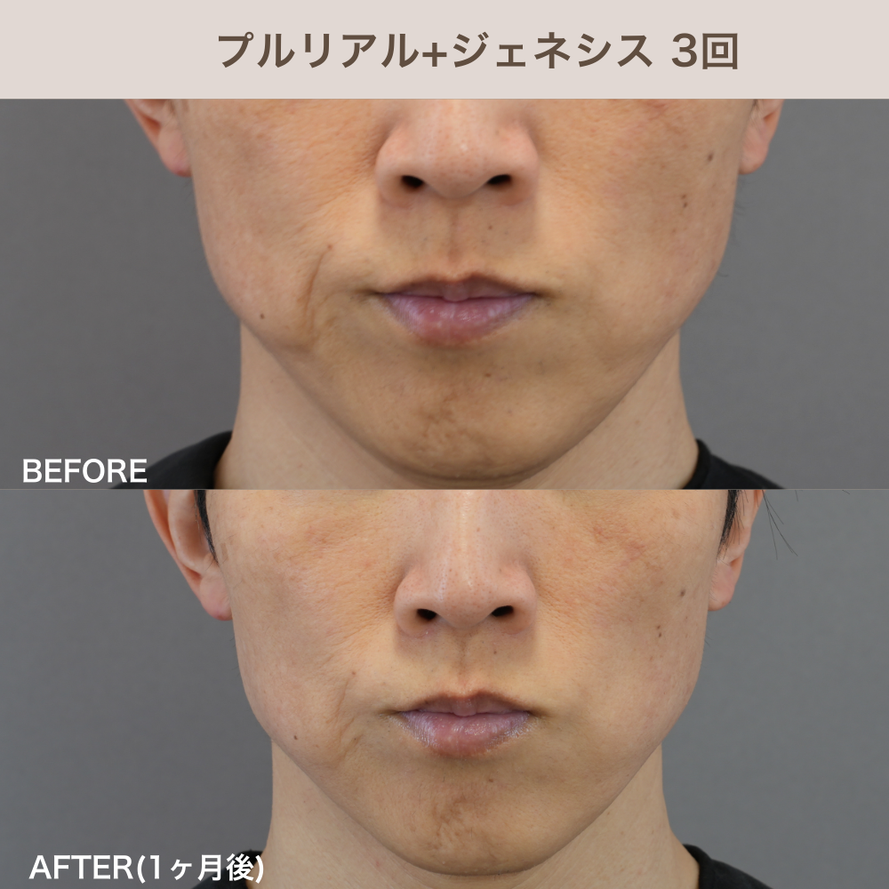 プルリアル+ジェネシス3回