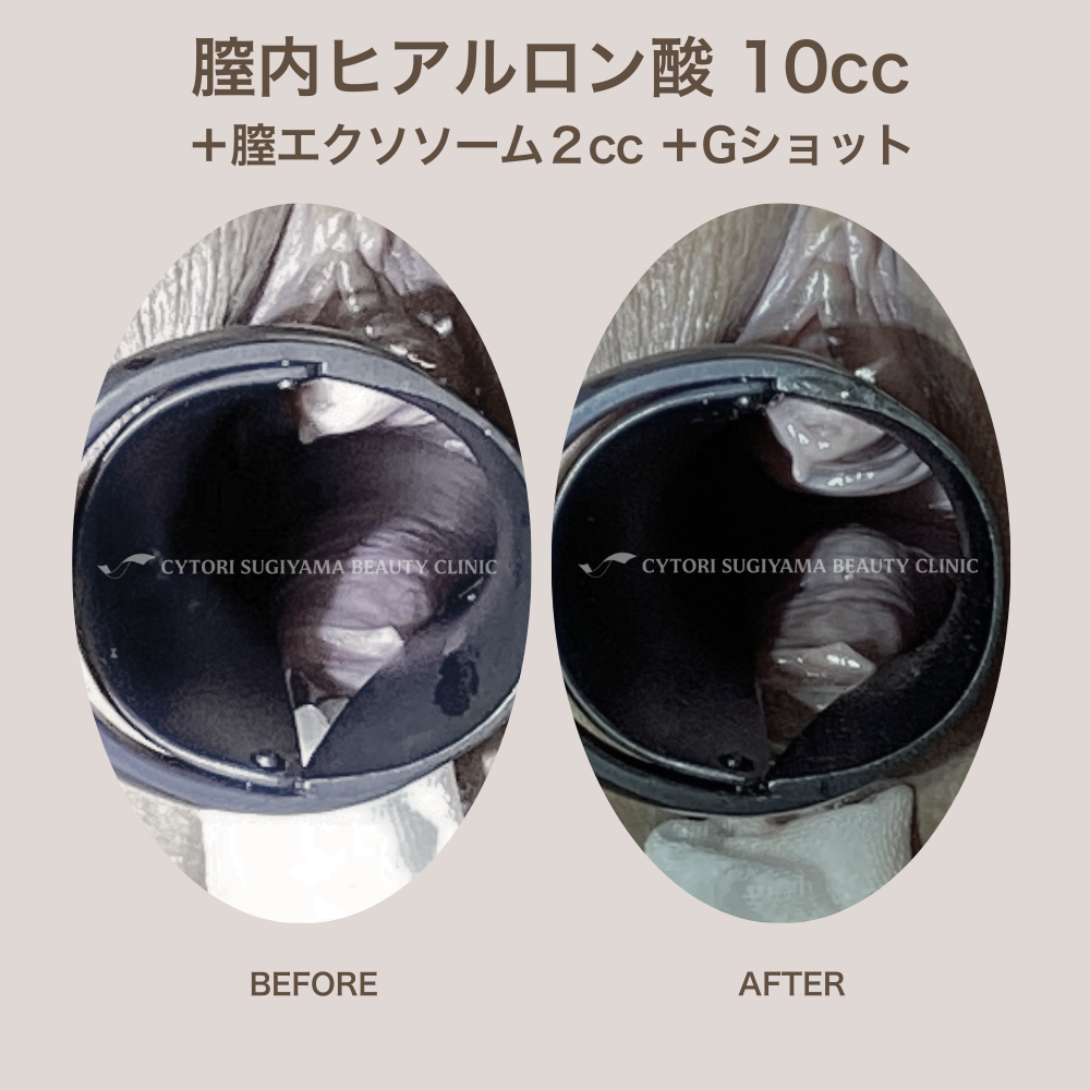 膣内ヒアルロン酸注入 10本まで+膣エクソソーム2cc+Gスポットヒアルロン酸注入