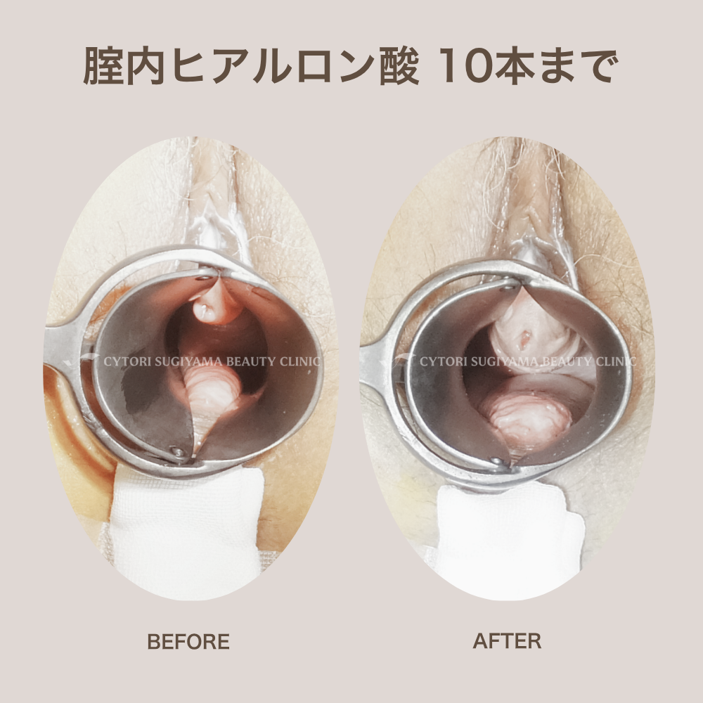 膣内ヒアルロン酸注入 10本まで