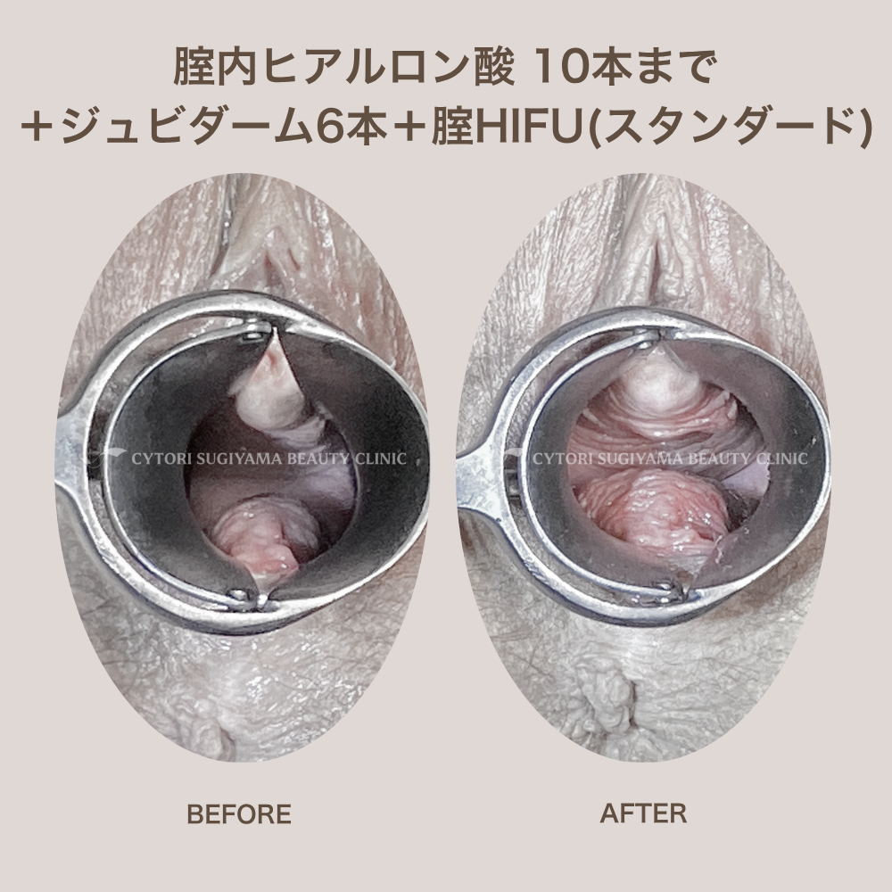 膣ヒアルロン酸10本まで+ジュビダーム6本+膣HIFU（スタンダード）