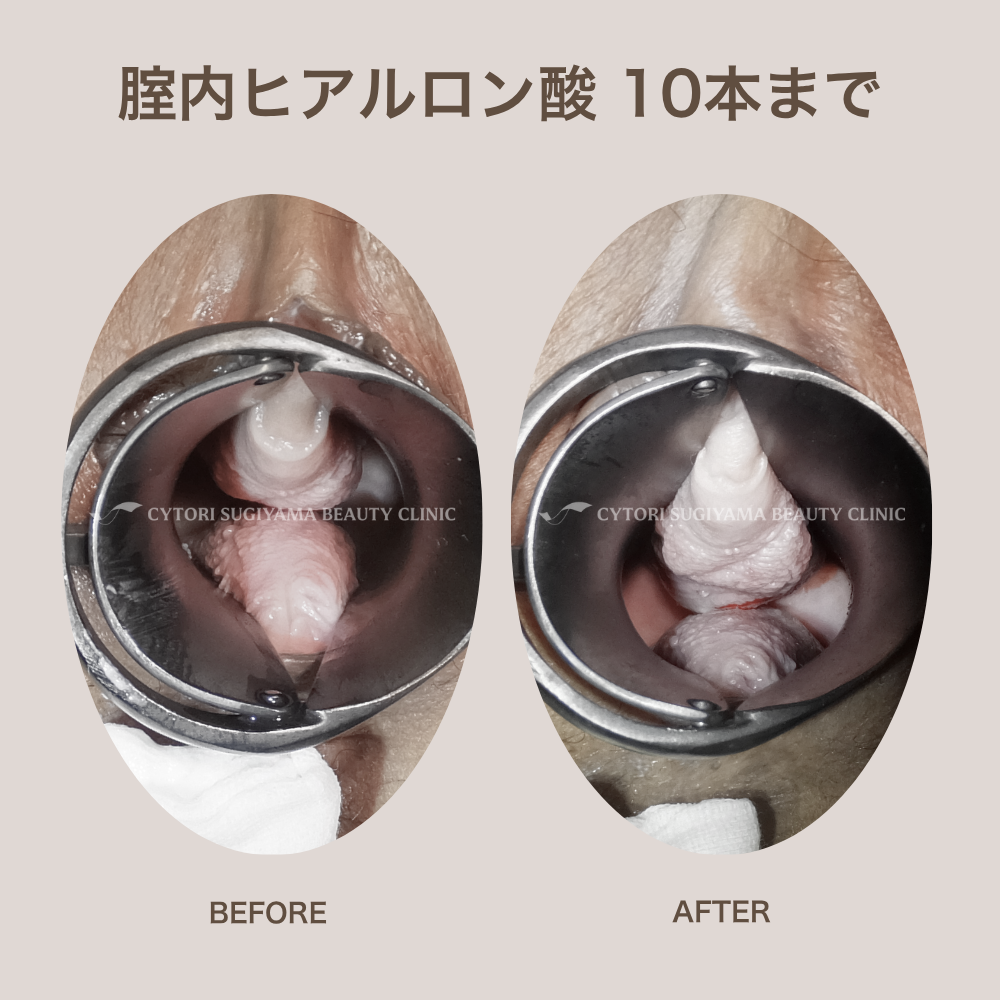 膣内ヒアルロン酸注入 10本まで