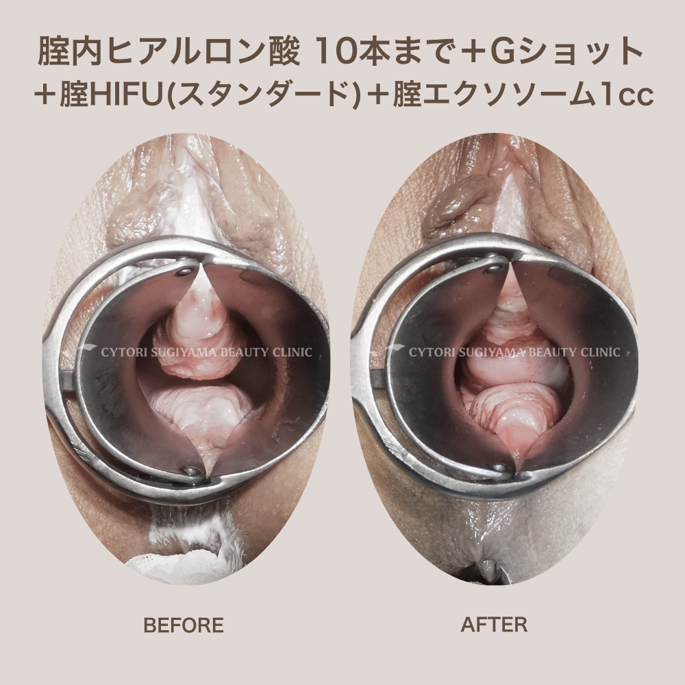 膣ヒアルロン酸10本まで+Gショット+膣HIFU（スタンダード）+膣エクソソーム1cc