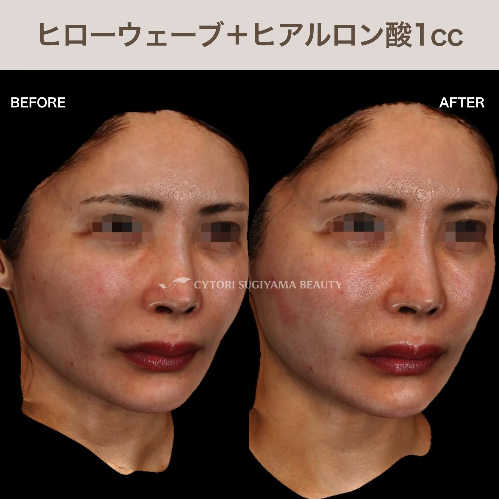 ヒローウェーブ+ヒアルロン酸