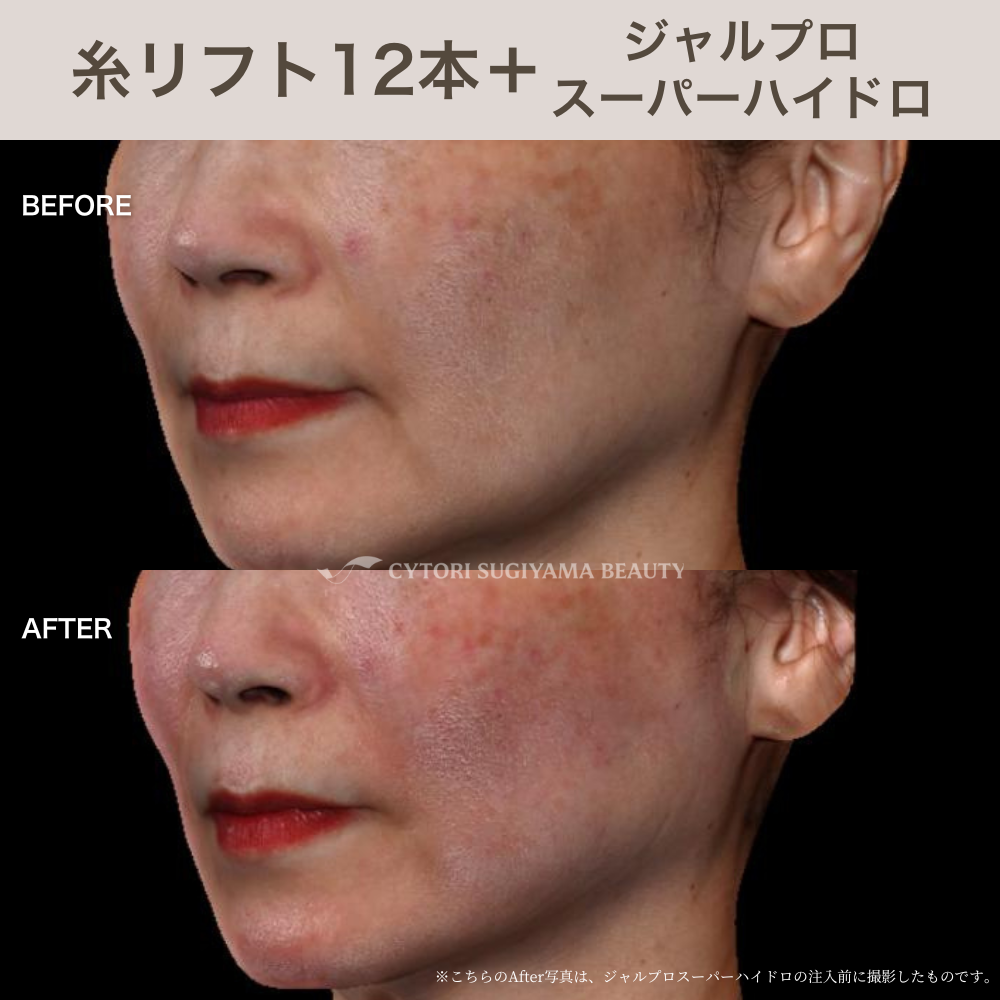 糸リフト12本+ジャルプロスーパーハイドロ