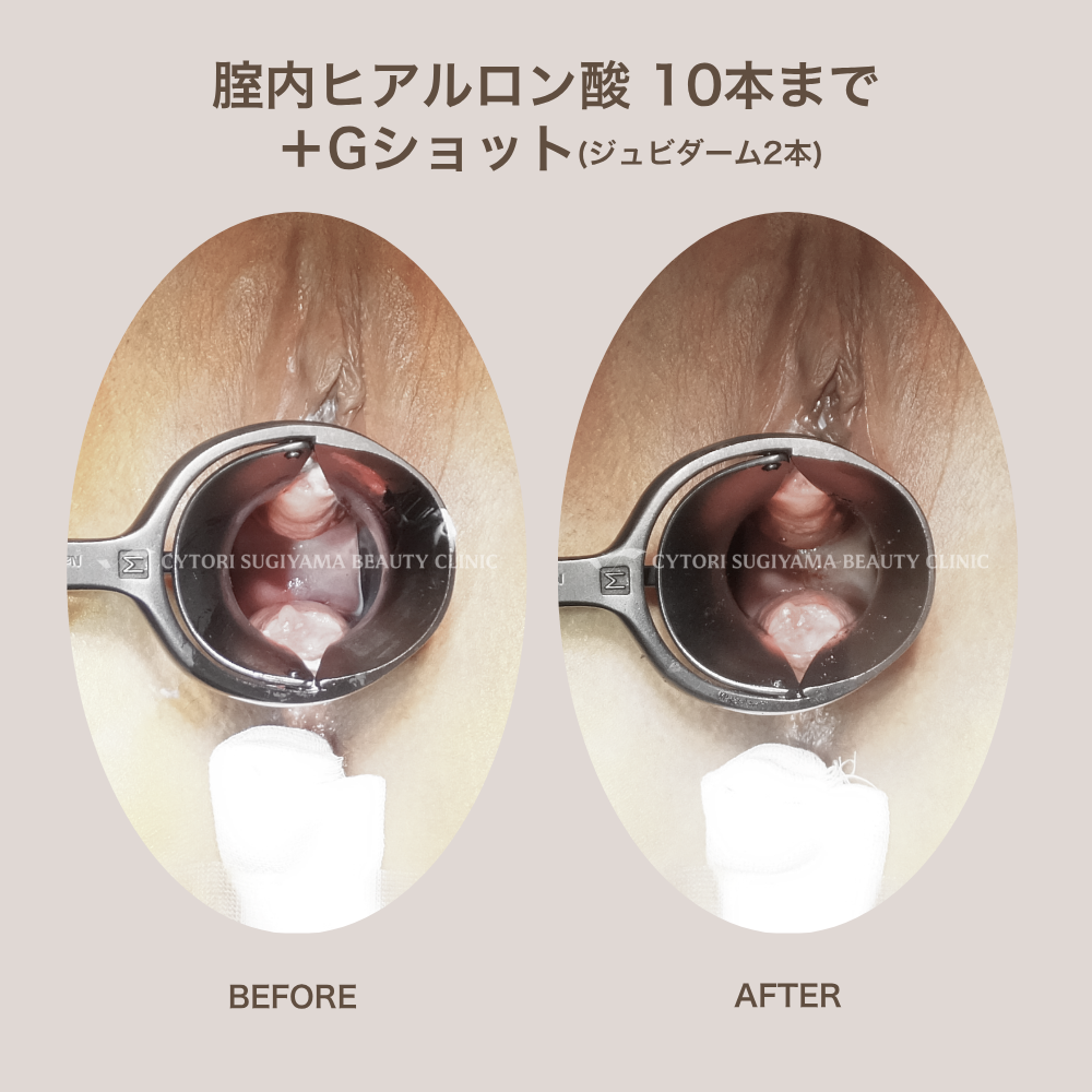 膣内ヒアルロン酸10本まで+Gショットヒアルロン酸注入（ジュビダーム２本）