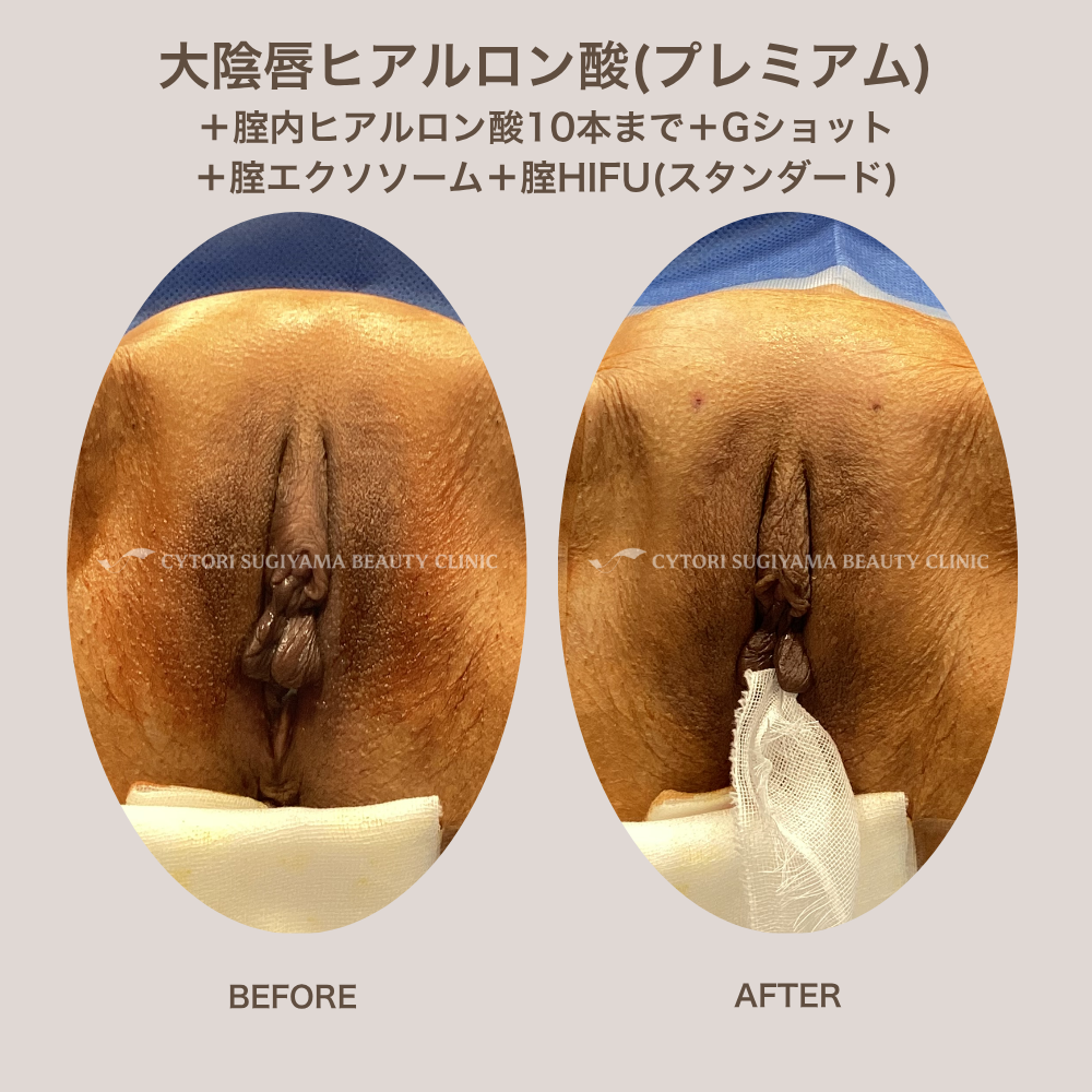 大陰唇ヒアルロン酸（プレミアム）+膣内ヒアルロン酸10本まで+Gショット+膣エクソソーム+膣HIFU（スタンダード）