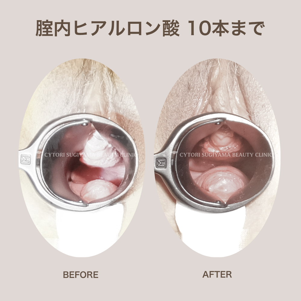 膣内ヒアルロン酸10本まで