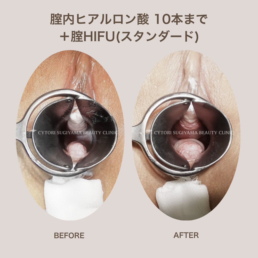 膣内ヒアルロン酸10本まで-膣HIFU（スタンダード）