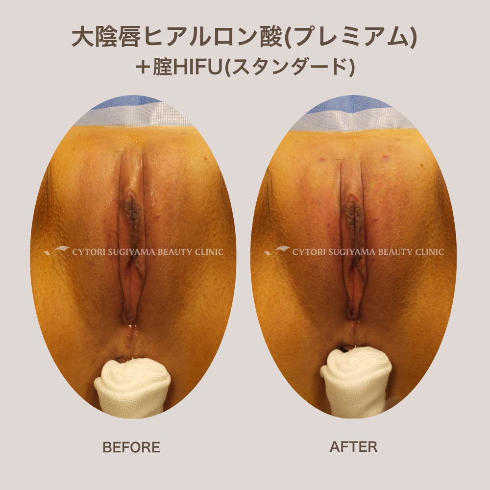 大陰唇ヒアルロン酸（プレミアム）+膣HIFU（スタンダード）