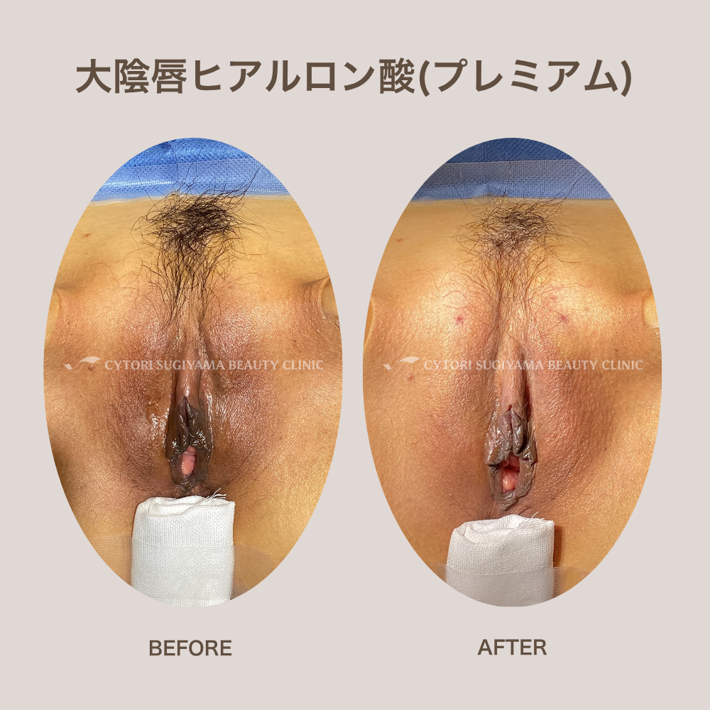 大陰唇ヒアルロン酸（プレミアム）