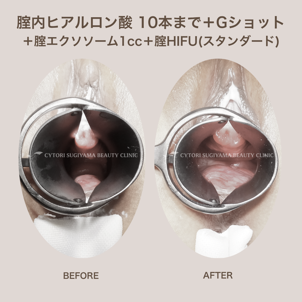 膣内ヒアルロン酸10本まで+膣エクソソーム1cc+膣ＨＩＦＵ（スタンダード）