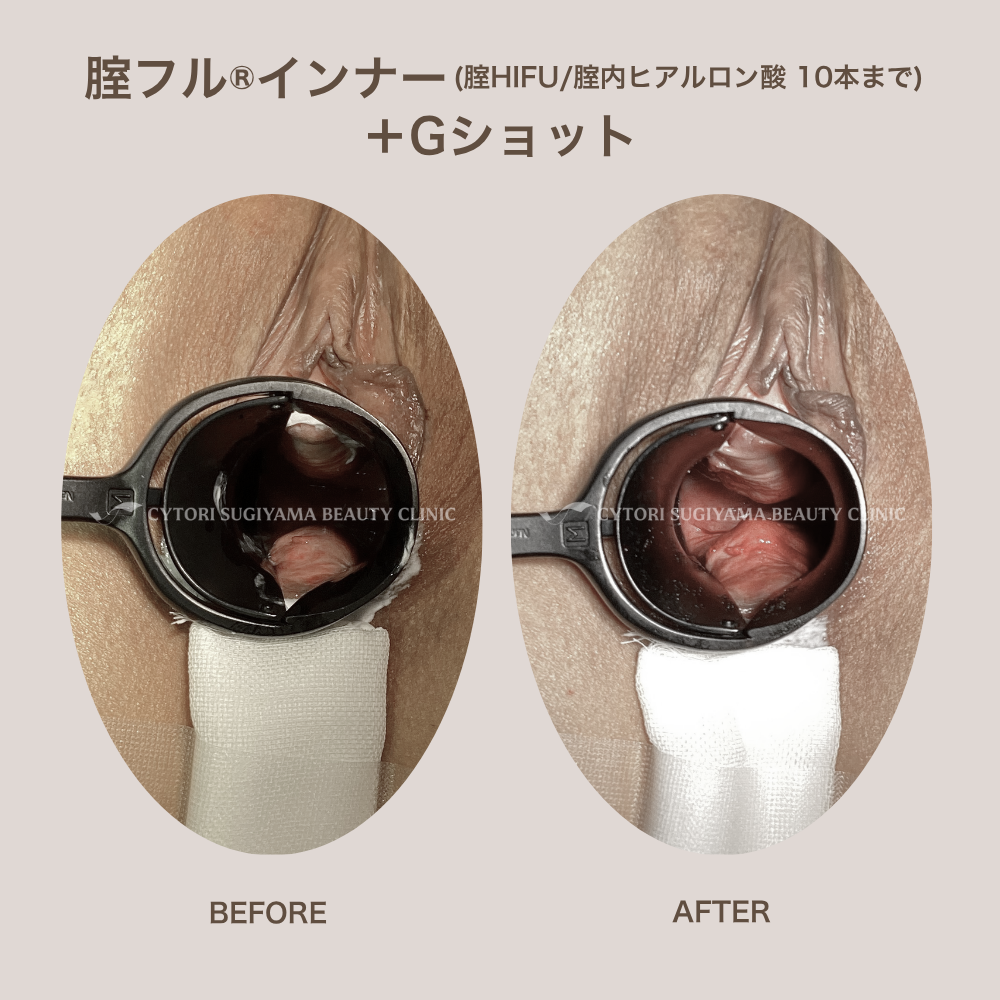 膣フル®インナー(膣HIFU/膣内ヒアルロン酸10本まで)+Gショット