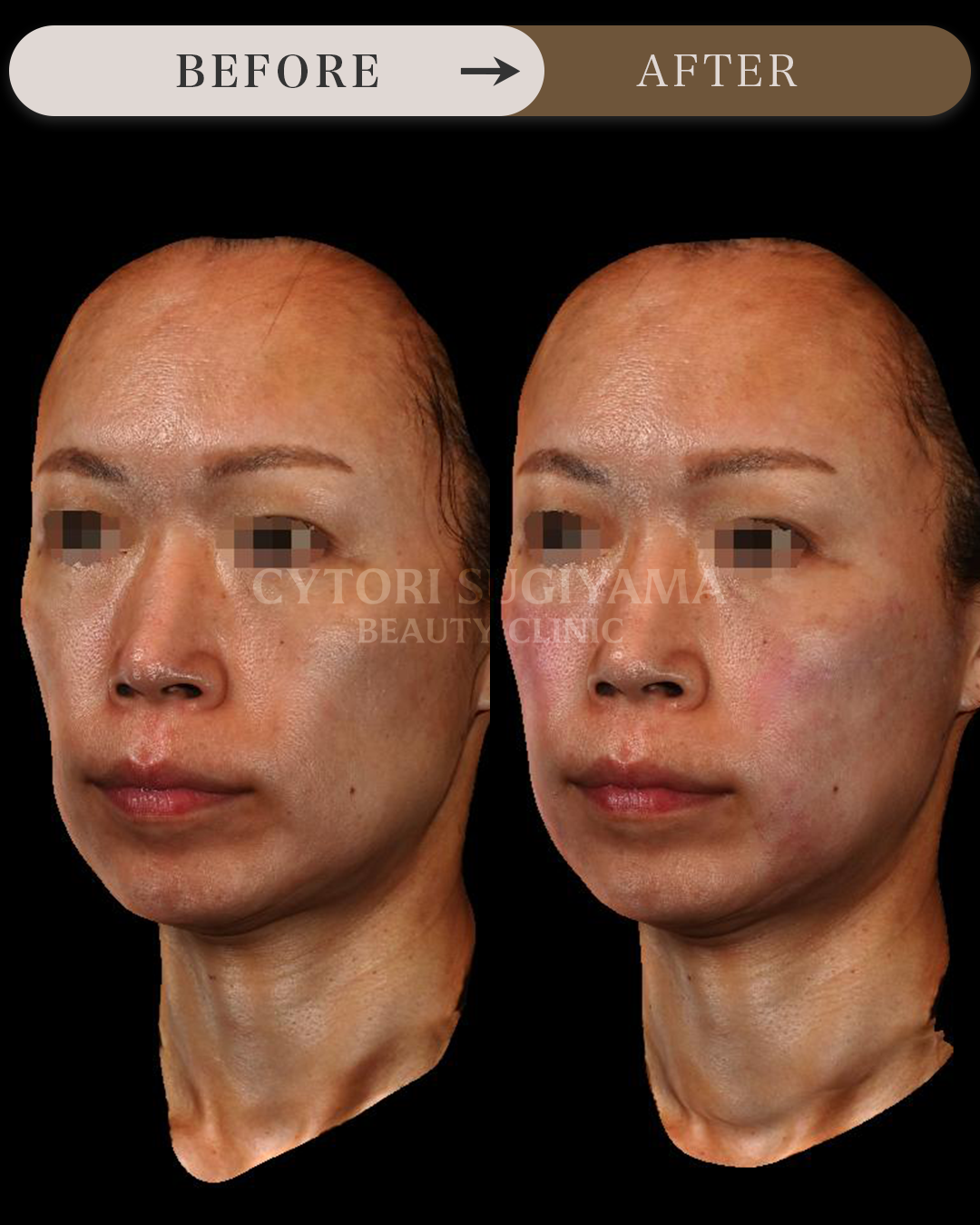 婦人科形成を受けられる前後の画像
