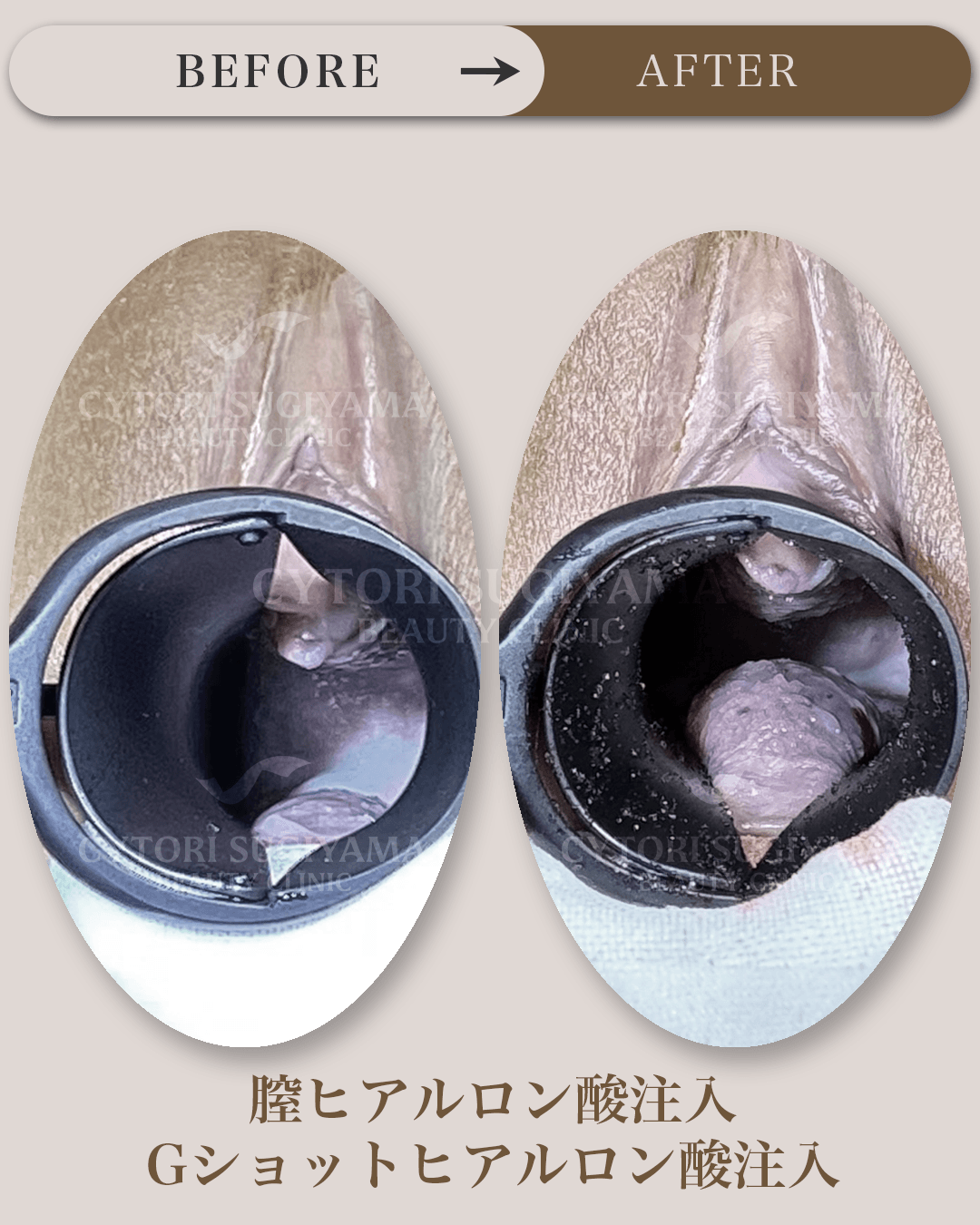 美容婦人科を受けられる前後の画像