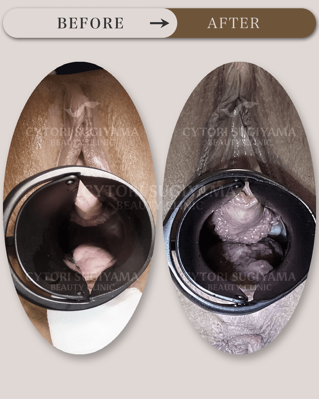 美容婦人科を受けられる前後の画像