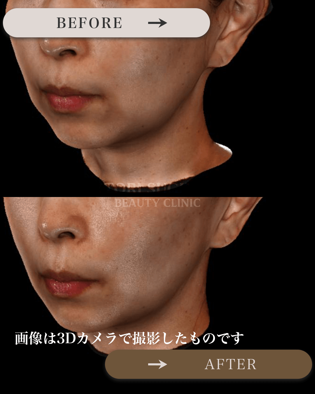 ぽにょりんを受けられる前後の画像