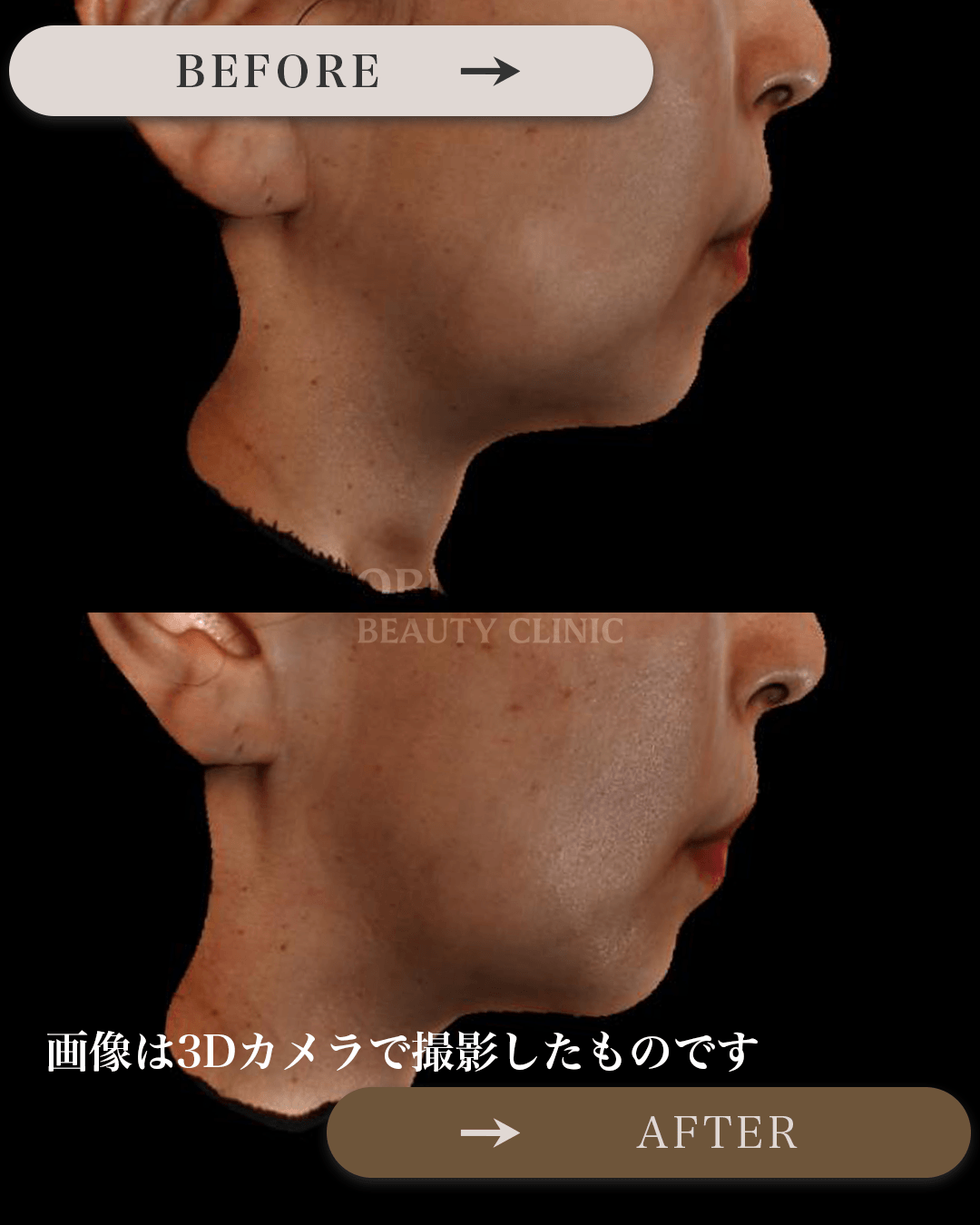 ぽにょりんを受けられる前後の画像