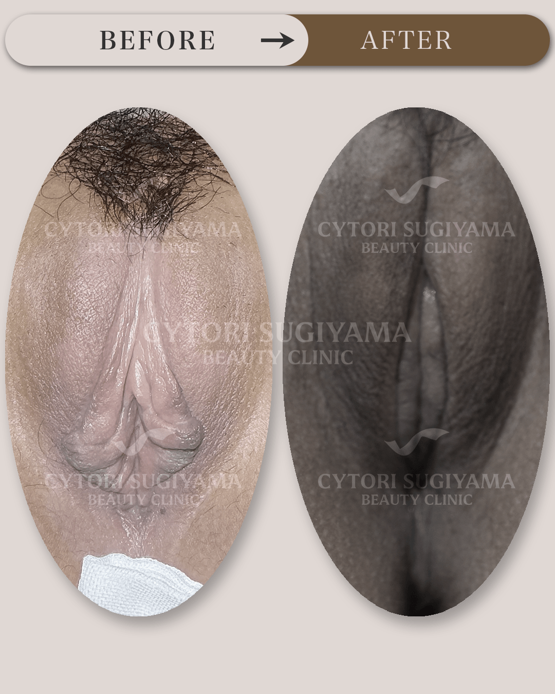 婦人科形成を受けられる前後の画像
