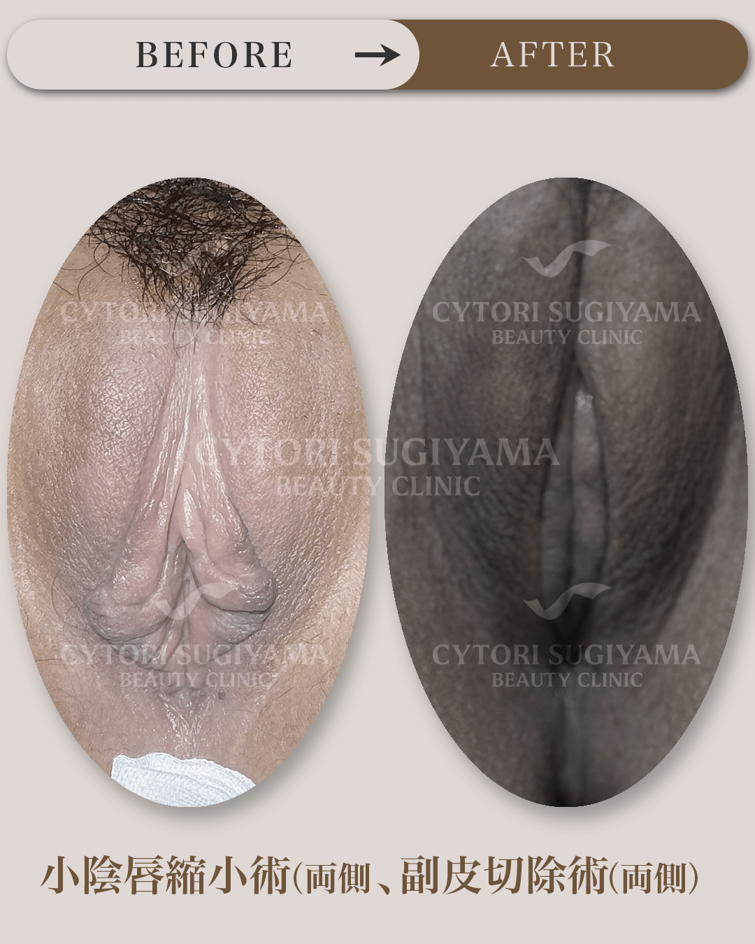 婦人科形成を受けられる前後の画像