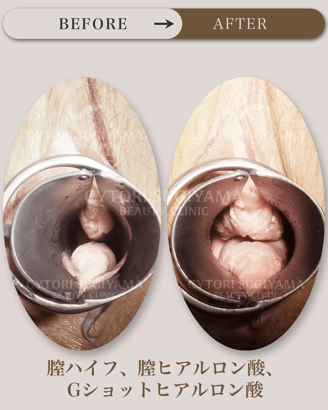 美容婦人科を受けられる前後の画像