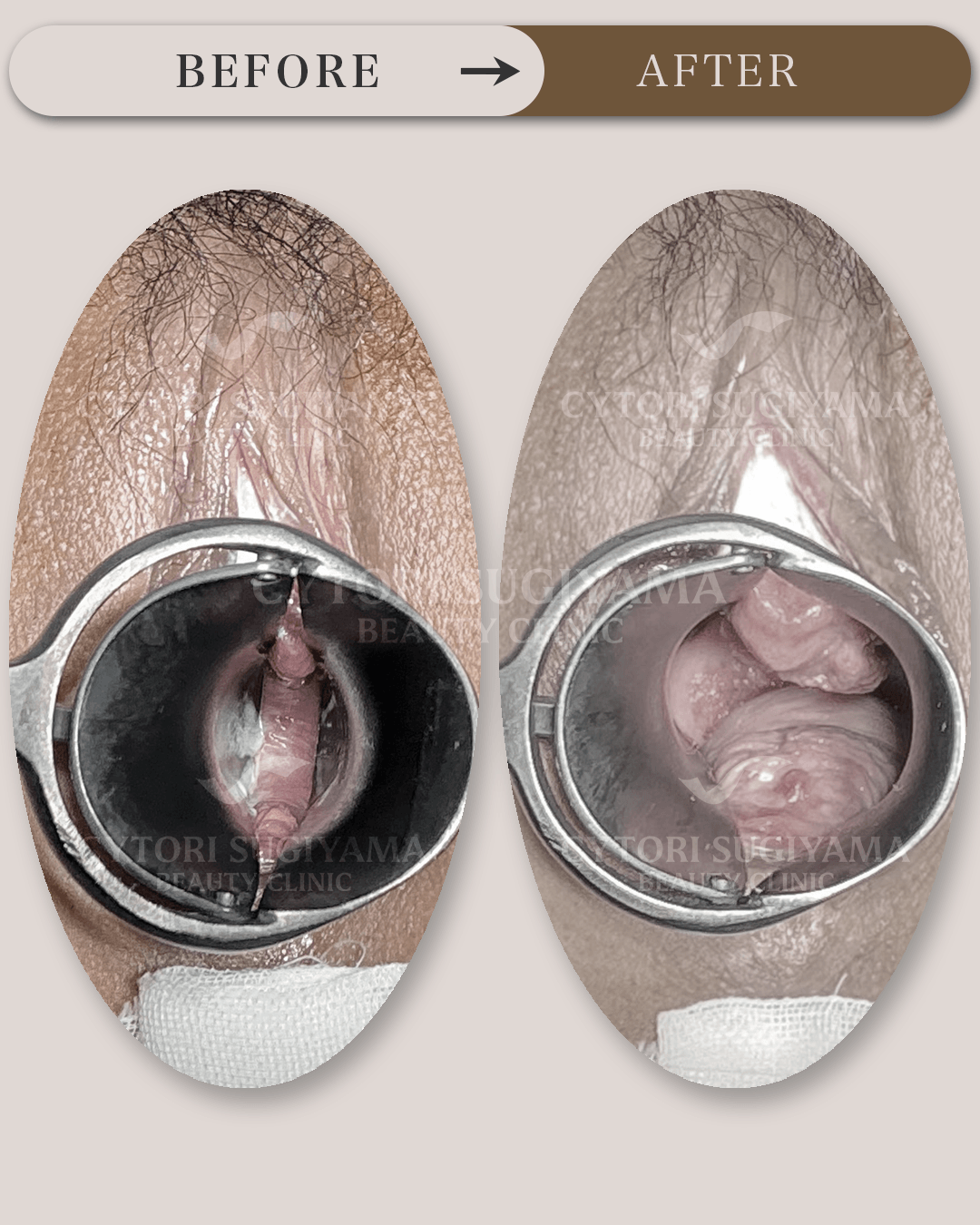 膣ヒアルロン酸注入を受けられる前後の画像