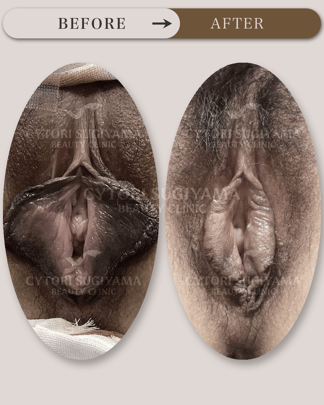婦人科形成を受けられる前後の画像
