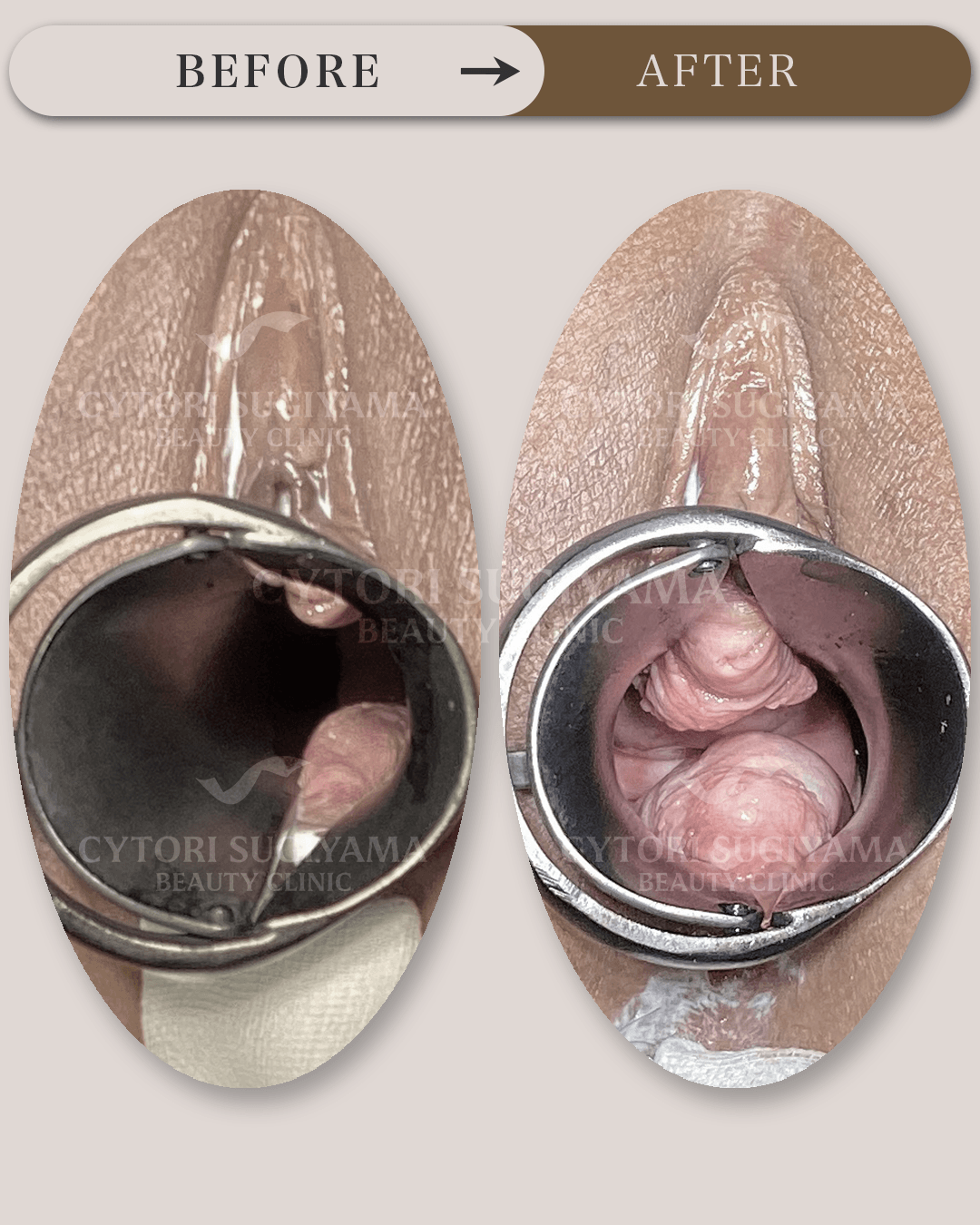 膣ヒアルロン酸注入を受けられる前後の画像