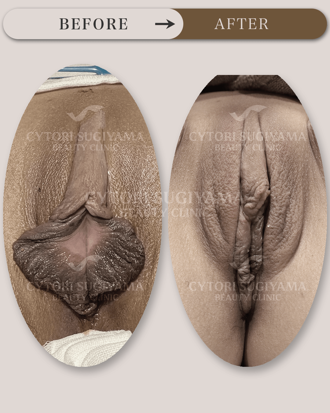 婦人科形成を受けられる前後の画像