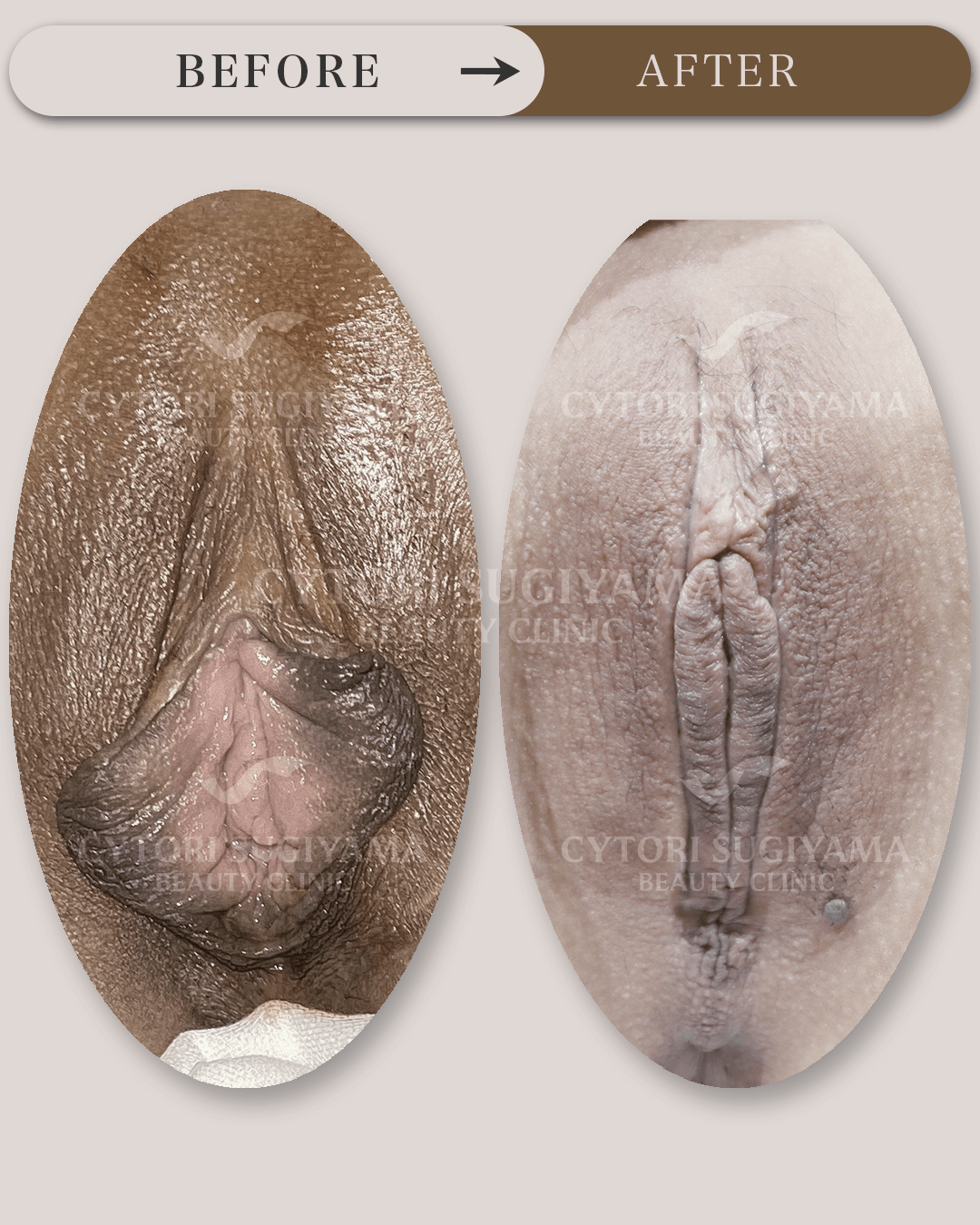 婦人科形成を受けられる前後の画像