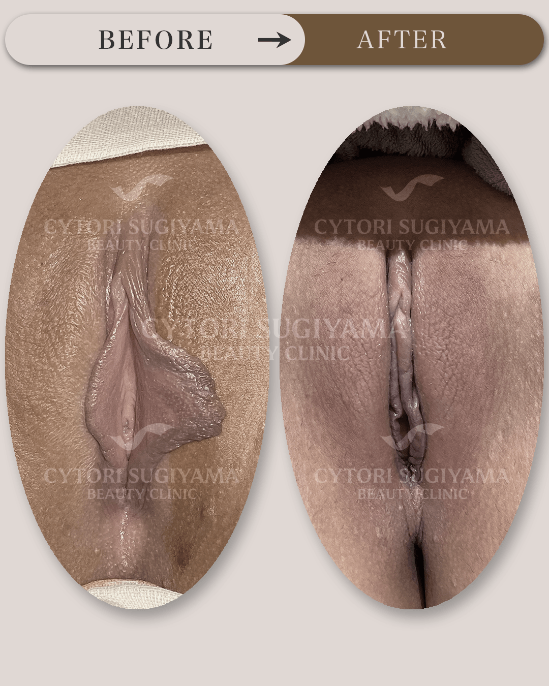 婦人科形成を受けられる前後の画像